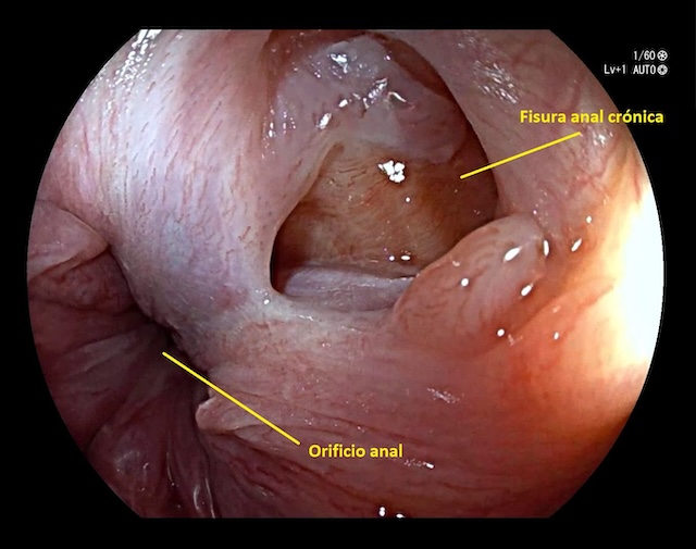 Fisura Anal