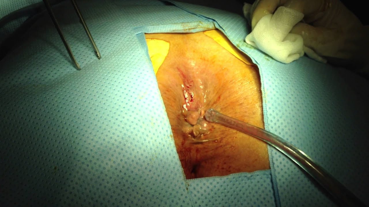 Abscesos