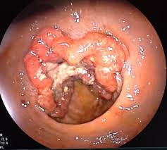 Cáncer de Recto